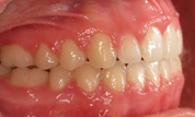 gallery-patient-27c-after-left