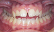 gallery-patient-27c-before-center