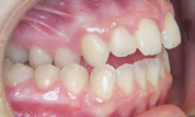 gallery-patient-27c-before-left