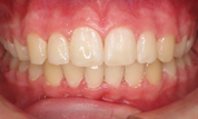 gallery-patient-28c-after-center
