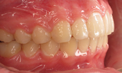 gallery-patient-28c-after-left