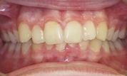 gallery-patient-28c-before-center
