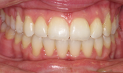 gallery-patient-29c-after-center