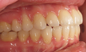 gallery-patient-29c-after-left