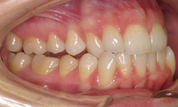gallery-patient-29c-before-left