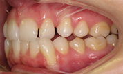 gallery-patient-29c-before-right