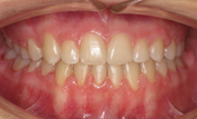 gallery-patient-30c-after-center
