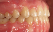 gallery-patient-30c-after-left