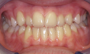 gallery-patient-30c-before-center