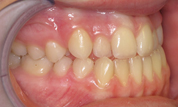 gallery-patient-30c-before-left