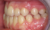 gallery-patient-30c-before-right