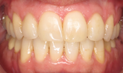 gallery-patient-32c-after-center