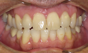 gallery-patient-32c-before-center