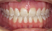 gallery-patient-33c-after-center