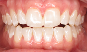 gallery-patient-33c-before-center