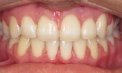 gallery-patient-34c-after-center