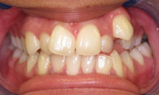 gallery-patient-34c-before-center