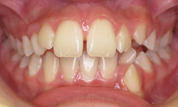 gallery-patient-36c-before-center