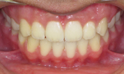 gallery-patient-39c-after-center