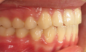 gallery-patient-39c-after-left