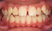 gallery-patient-39c-before-center