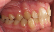 gallery-patient-39c-before-left