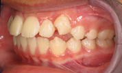 gallery-patient-39c-before-right