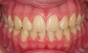 gallery-patient-40c-after-center