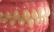 gallery-patient-40c-after-left