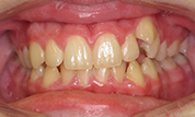 gallery-patient-40c-before-center