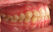 gallery-patient-40c-before-left