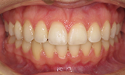 gallery-patient-41c-after-center