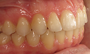 gallery-patient-41c-after-left