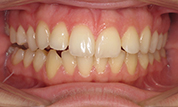 gallery-patient-41c-before-center