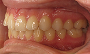 gallery-patient-41c-before-right