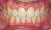 gallery-patient-42c-after-center