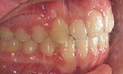 gallery-patient-42c-after-left
