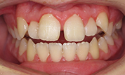 gallery-patient-42c-before-center