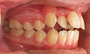 gallery-patient-42c-before-left