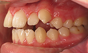 gallery-patient-42c-before-right