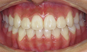 gallery-patient-43c-after-center