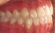 gallery-patient-43c-after-left