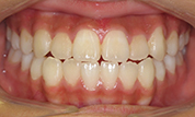 gallery-patient-43c-before-center