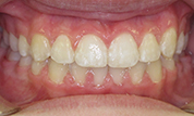 gallery-patient-44c-after-center