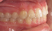 gallery-patient-44c-after-left