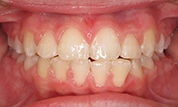 gallery-patient-44c-before-center