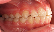 gallery-patient-44c-before-left