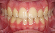 gallery-patient-45c-after-center