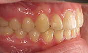gallery-patient-45c-after-left