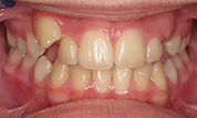 gallery-patient-45c-before-center